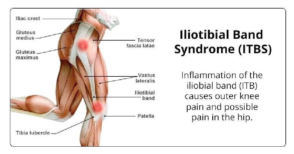 Síndrome de la banda iliotibial