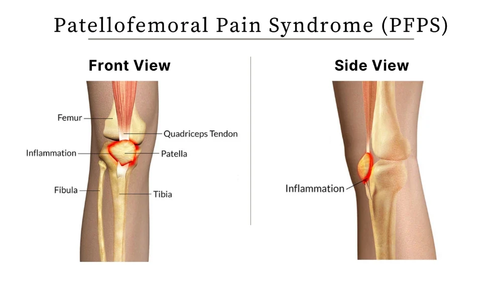 Síndrome de dolor patelofemoral